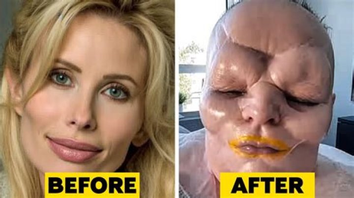 Alex Cooper Denied Rumors Of Plastic Surgery