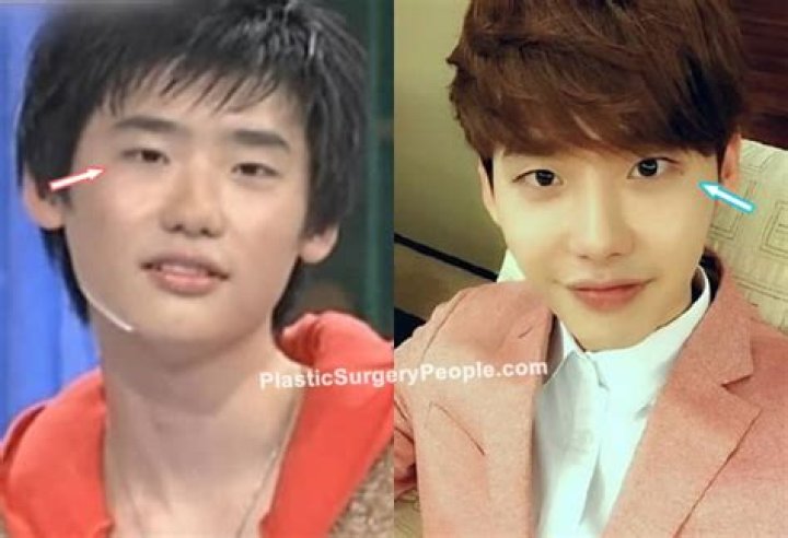 Lee Jong Suk | Before Plastic Surgery? Wrong With His Face?